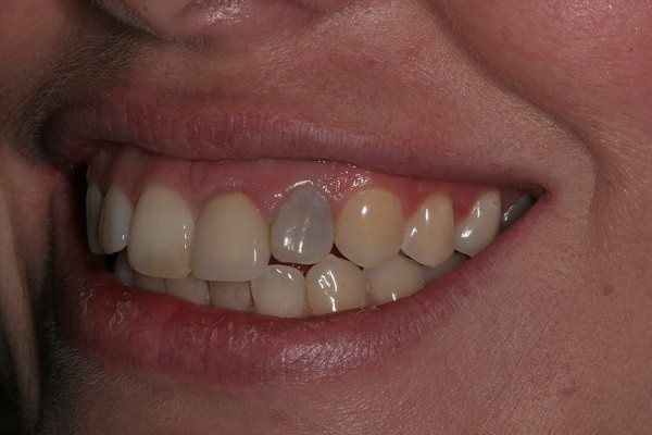 Can a grey tooth be saved
