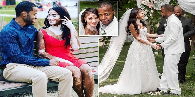 Can I Marry A Girl Whose Mother Has Vitiligo