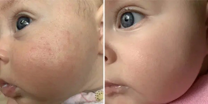 Does Tubby Todd Help With Baby Acne